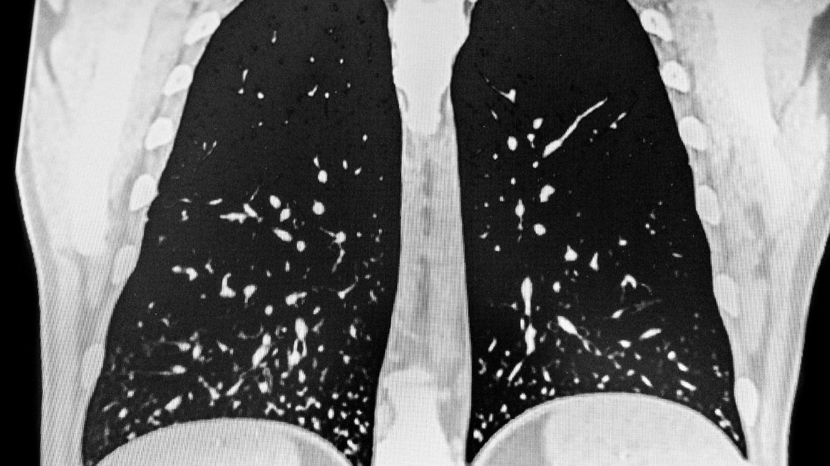 Histoplazmoza, inaczej choroba Darlinga to infekcja grzybicza wywoływana przez dimorficzny grzyb Histoplasma capsulatum.