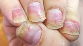 Objawy łuszczycy na paznokciach. Nie ignoruj takich zmian