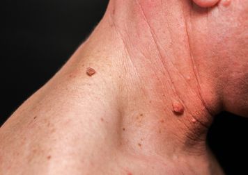Masz takie zmiany na skórze? Znak, że insulina szybuje w górę