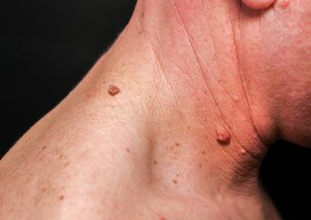 Masz takie zmiany na skórze? Znak, że insulina szybuje w górę