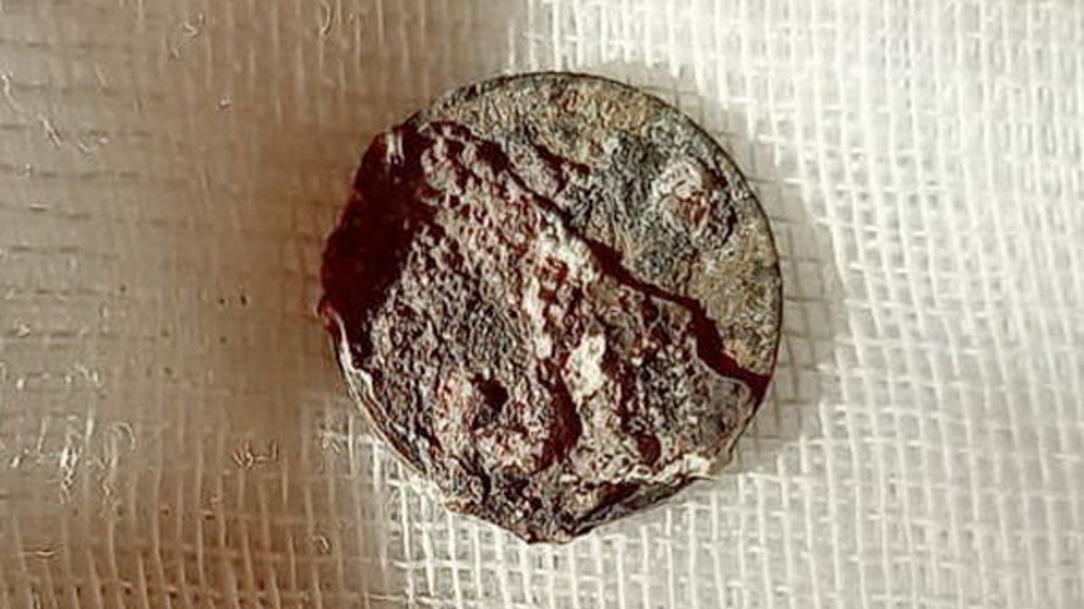 Mężczyzna miał w nosie monetę o nominale jednej kopiejki. 