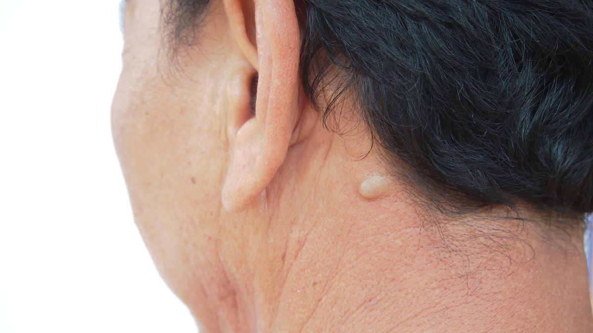 Kaszak to torbiel o wielkości od kilku milimetrów do kilku centymetrów.