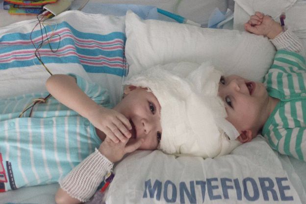 Po 27-godzinnej operacji rozdzielono bliźnięta syjamskie