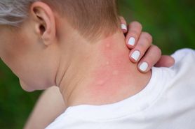 Dlaczego komary atakują okolice głowy i uszu? "Wyczuwają zapach"