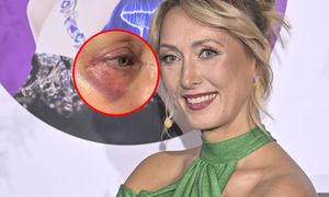 Pokazała się z siniakami wokół oka. "Do wesela się zagoi"