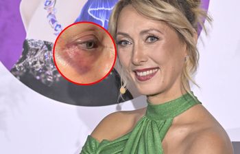 Pokazała się z siniakami wokół oka. "Do wesela się zagoi"