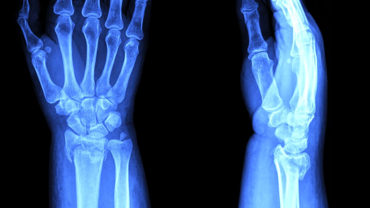 Naukowcy ostrzegają przed chorobami autoimmunologicznymi takimi jak reumatoidalne zapalenie stawów