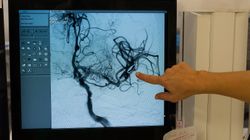 Tętniaki a COVID. "Można porównać to do pęknięcia rury gazowej"