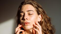 Problemy z cerą? Co jeść, a czego unikać w walce z trądzikiem?