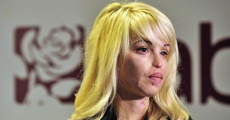 13 lat temu została oblana kwasem. Katie Piper dotychczas przeszła 400. operacji