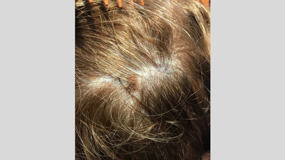 Zmiana na skórze głowy