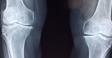 Osteoklasty – powstawanie, budowa i funkcje komórek kościogubnych
