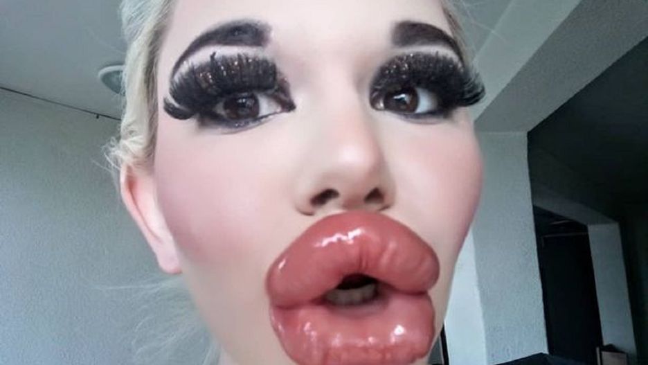 "Żywa Barbie" jest po 20 zastrzyku powiększającym usta