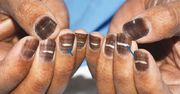 Nietypowe skutki chemioterapii. Pacjent z brązowymi paznokciami