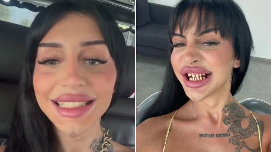 Zdecydowała się na "tureckie zęby". Gdy otworzyła usta, internauci zaniemówili