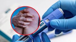 Specyficzny skutek uboczny, który może dawać. Ozempic Czuć go na skórze