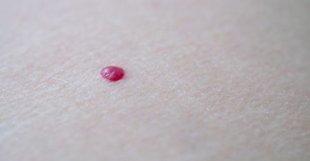 Pojawia się na skórze. Może zwiastować niewydolność żylną