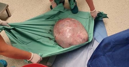 To kolejny tak ogromny guz jajnika, który wycięto. Ważył 17 kg