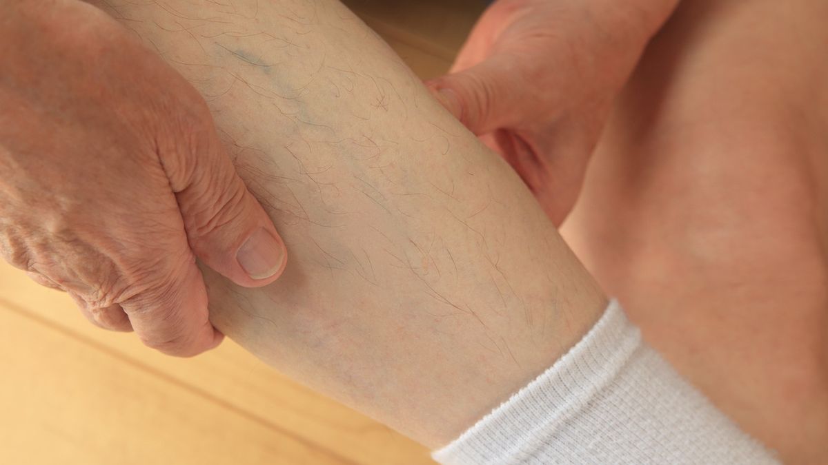 Zakrzepica może dawać niecharakterystyczne objawy