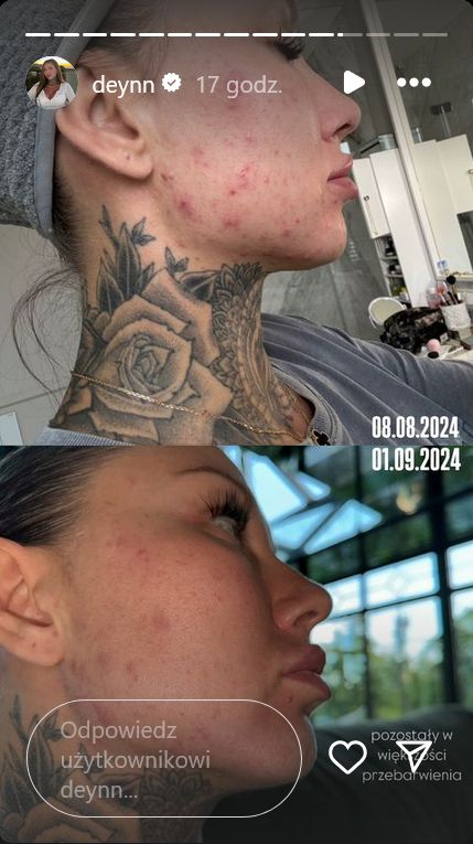 Deynn walczyła z trądzikiem.