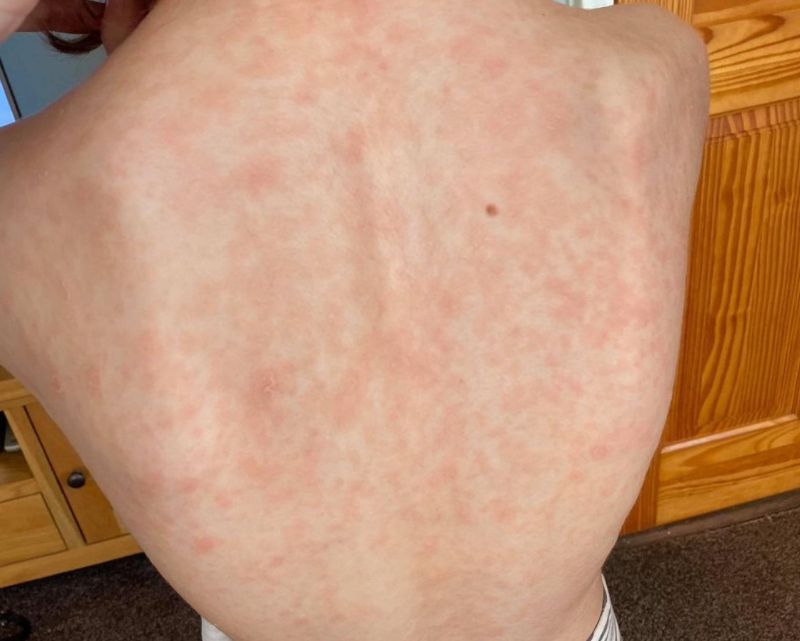 Dzieci często mają zmiany skórne