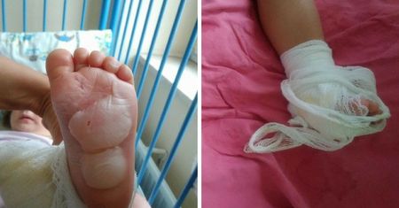 2-letnia Maja poparzyła się w parku miejskim. Matka winą obarcza właściciela obiektu