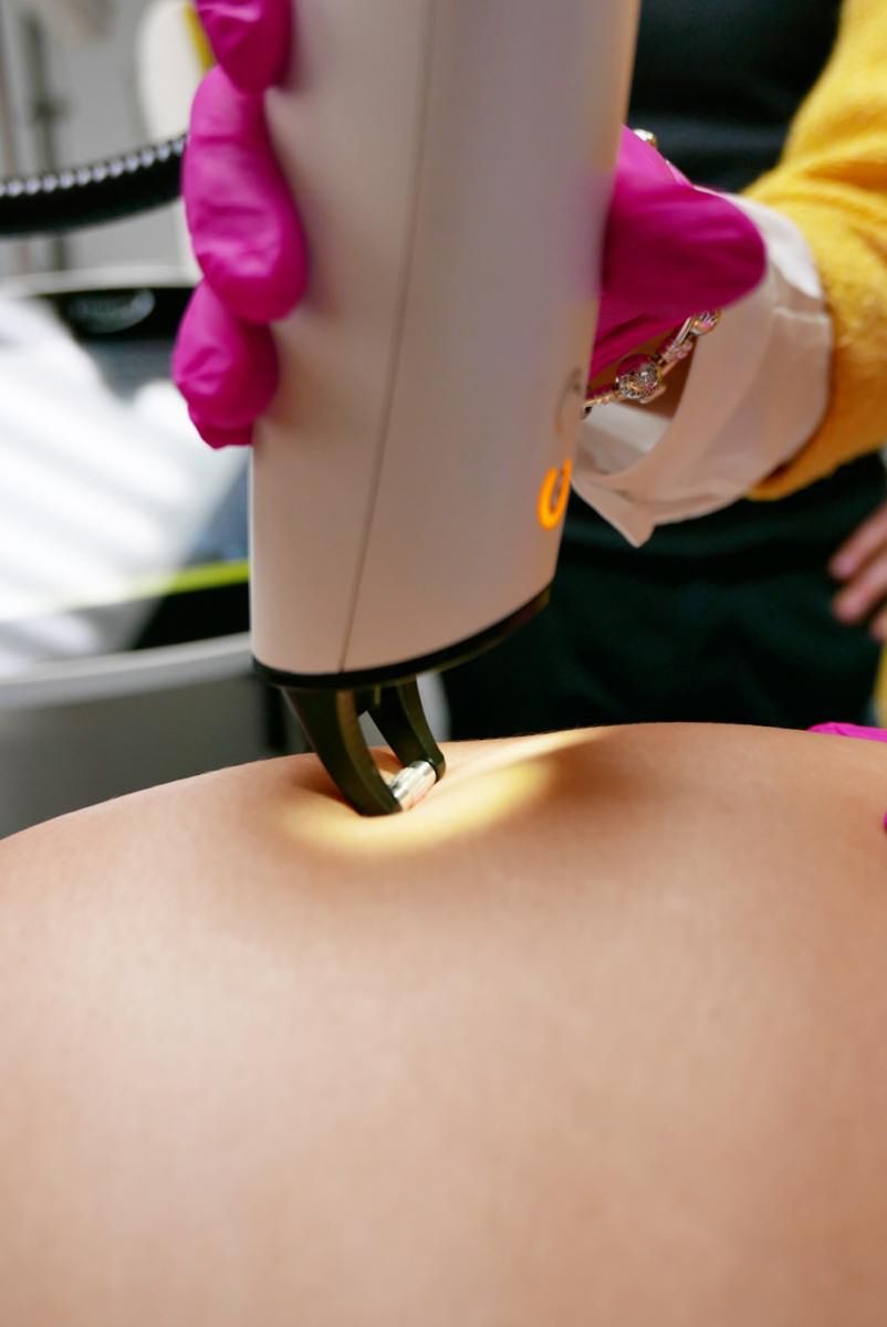 Laseroterapia jest coraz popularniejszą metodą z zakresu medycyny estetycznej