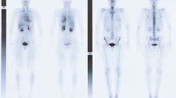 Scyntygrafia kości - wskazania, badanie w chorobach nowotworowych, przebieg