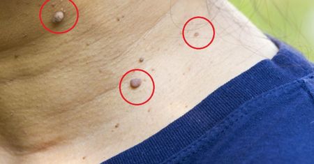 Pojawiają się na szyi. Mogą wskazywać na rozwój groźnego nowotworu
