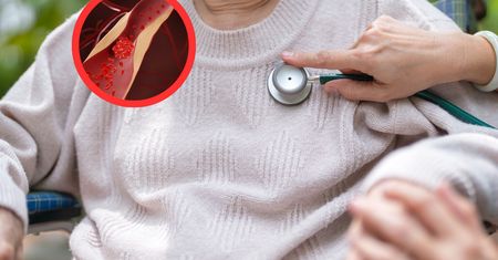 W USA nowe wytyczne. Zaostrzyli progi dla cholesterolu