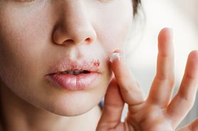 Opryszczka na ustach – jak ją rozpoznać i leczyć? Domowe sposoby na opryszczkę wargową
