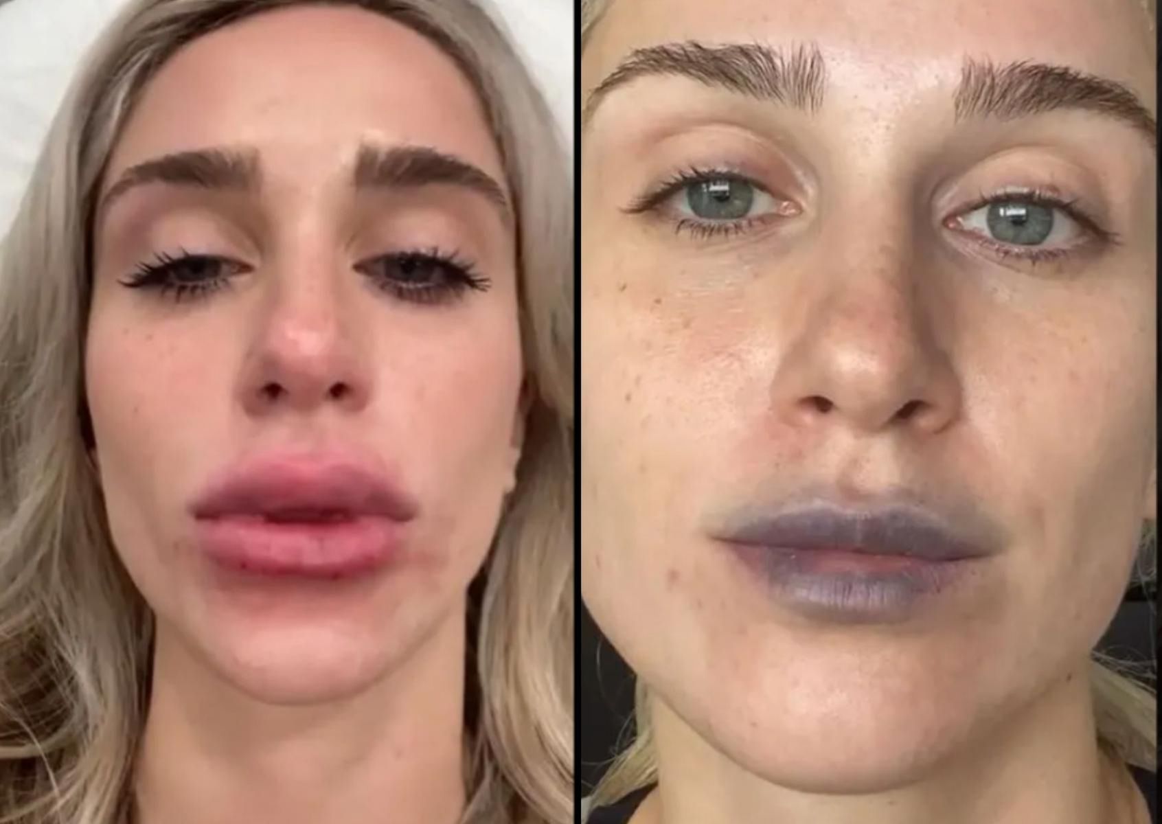 Chciała upiększyć usta. &quot;Po wypełnieniu są spuchnięte, niebieskie i grudkowate&quot;