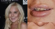 ŻÓŁTE ZĘBY Lindsay Lohan! (WSTYD?)