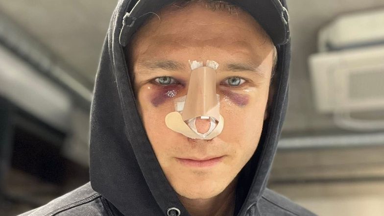 Jakub Rzeźniczak chwali się nosem w opatrunkach