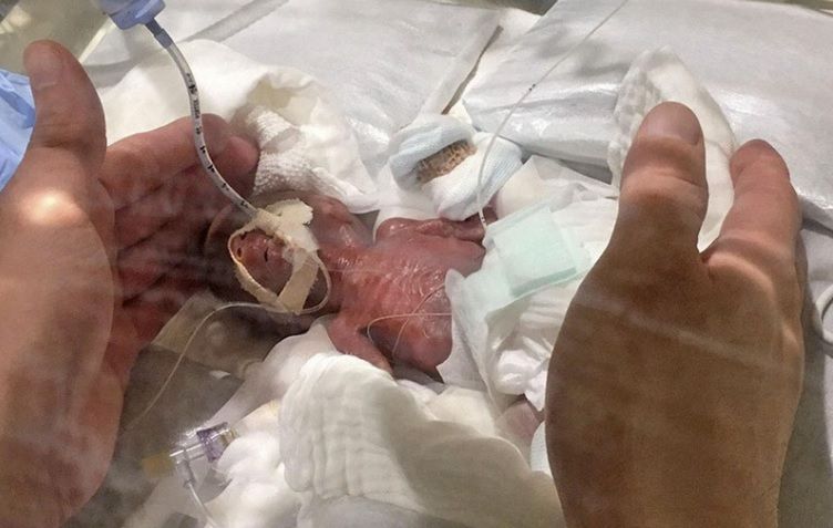 Najmniejszy chłopiec na świecie ważył 268 g 