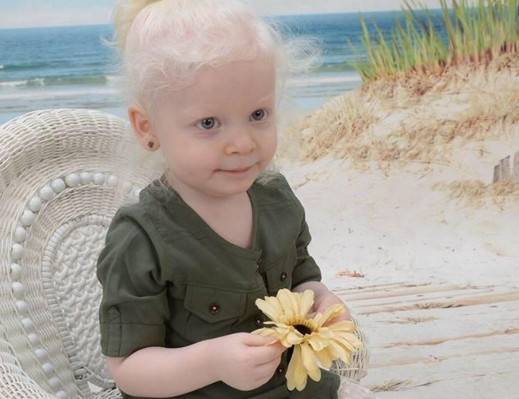 Zerina cierpi na zespół Hermanskiego-Pudlaka