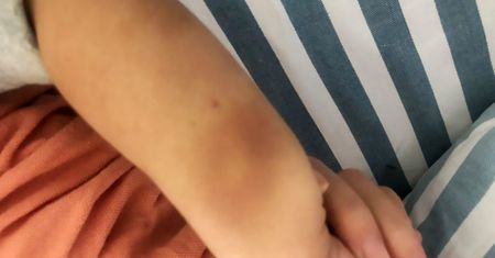 Siniaki na ciele 2-latka pojawiły się "bez przyczyny". Usłyszała wstrząsającą diagnozę