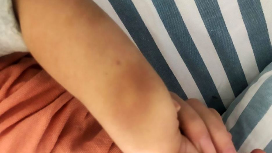 Siniaki na ciele 2-latka pojawiły się bez przyczyny. Usłyszała wstrząsającą diagnozę