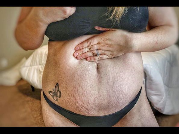 Kristyn Dingman uwielbia swoje rozstępy