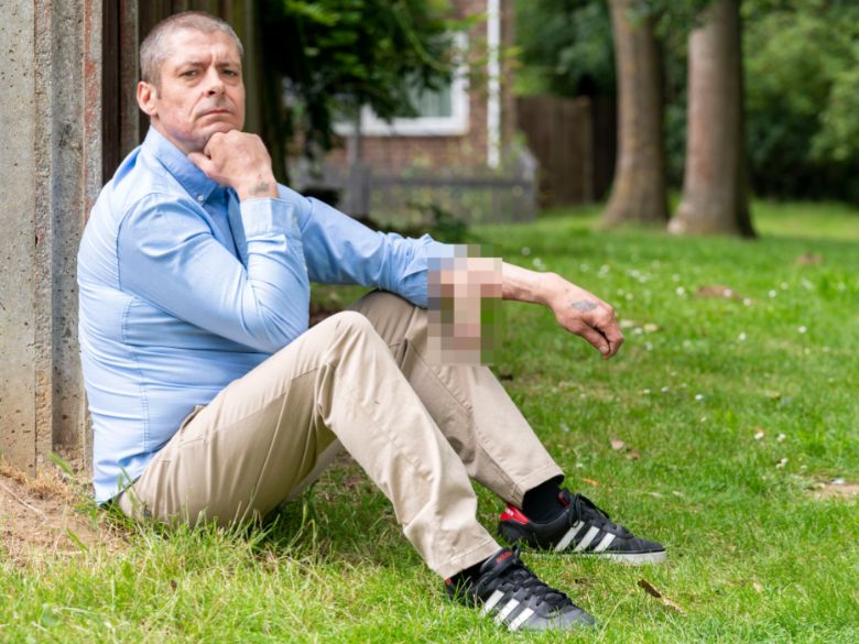 Przez sześć lat żył z penisem umocowanym do przedramienia