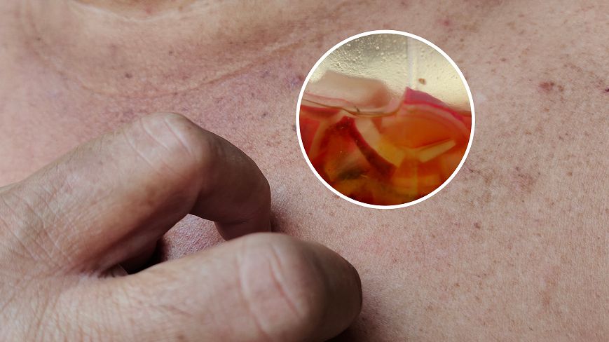 Jak usunąć przebarwienia i plamy starcze? Domowy sposób