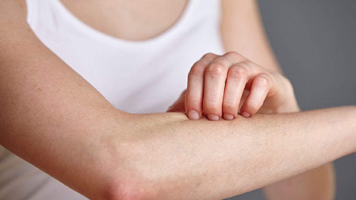 Jednym z nowych objawów jest wysypka.