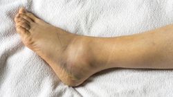 Zdejmujesz skarpetki, a na skórze zostaje ślad? Zwróć uwagę na układ limfatyczny