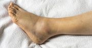 Zdejmujesz skarpetki, a na skórze zostaje ślad? Zwróć uwagę na układ limfatyczny