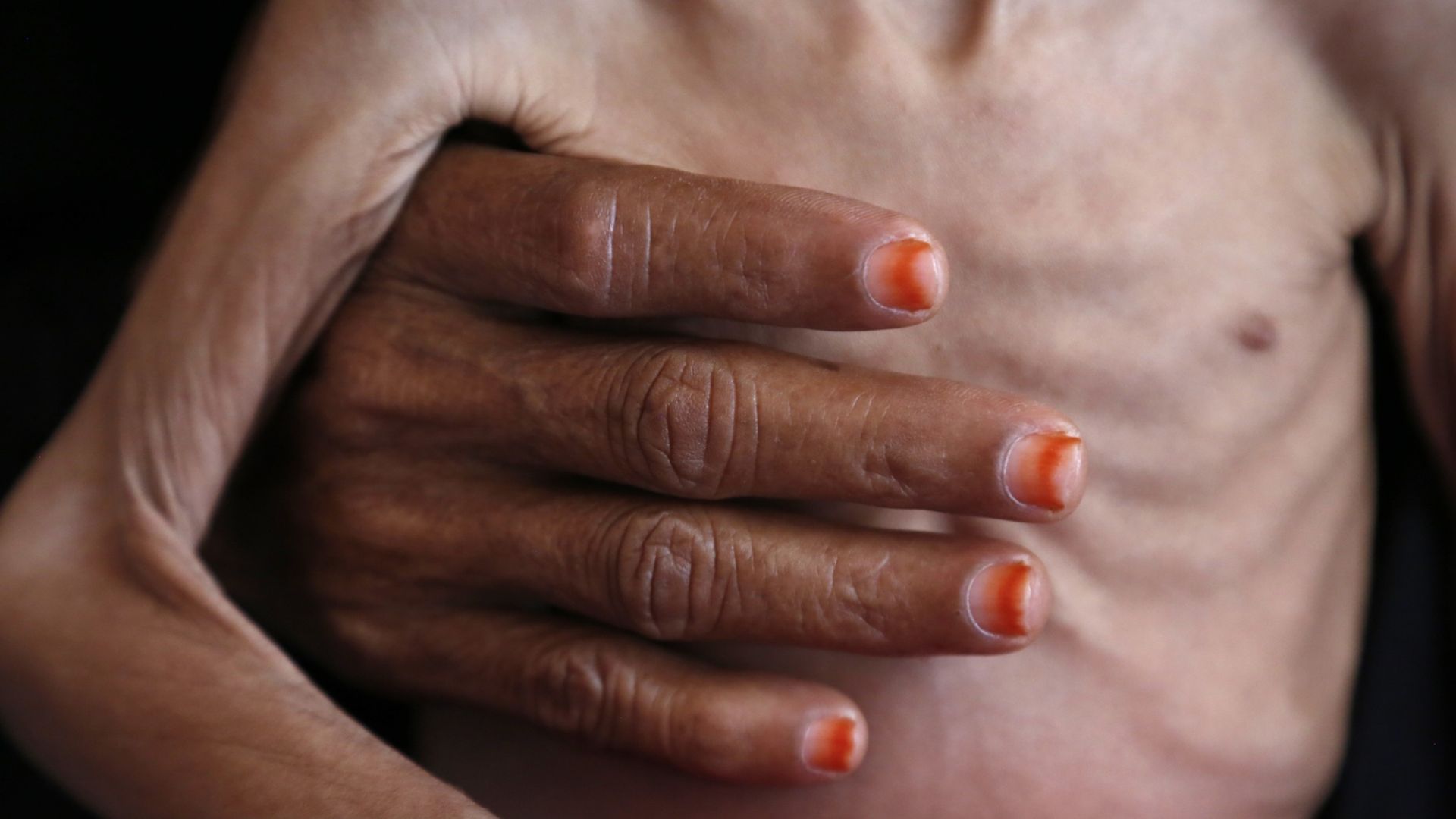 Dłoń dorosłej kobiety obejmuje ciało niedożywionego dziecka w Jemenie