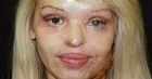 Katie Piper walczy o dawną twarz