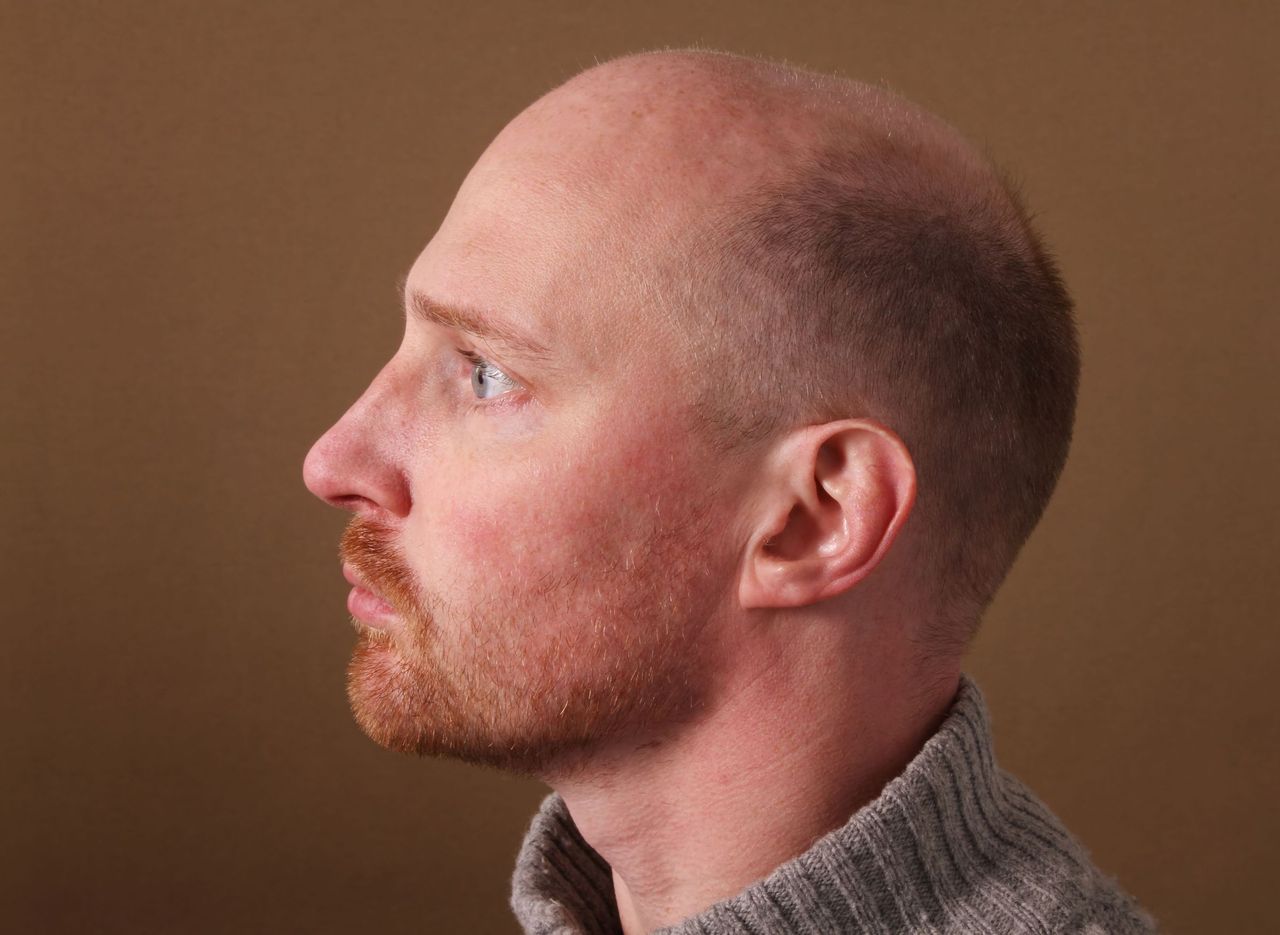 Wypadanie włosów u mężczyzn – przyczyny i leczenie