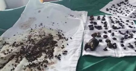 Wyjęli z jej ciała ponad 200 kamieni
