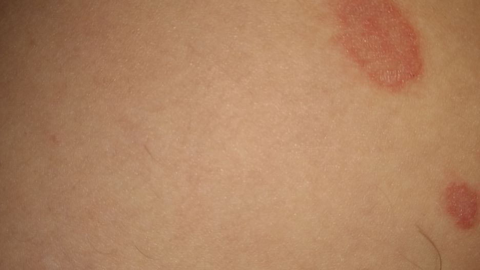 Dermatolog ocenił, że przyczyną alergii u partnera Pani Andżeliki jest woda