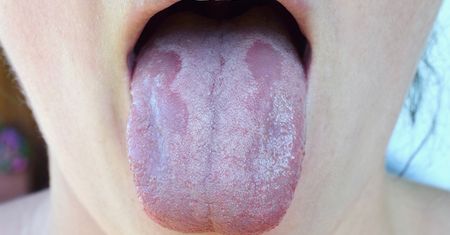 Kandydoza – czym jest drożdżyca wywołana Candida albicans? Objawy zakażenia, przyczyny i metody leczenia